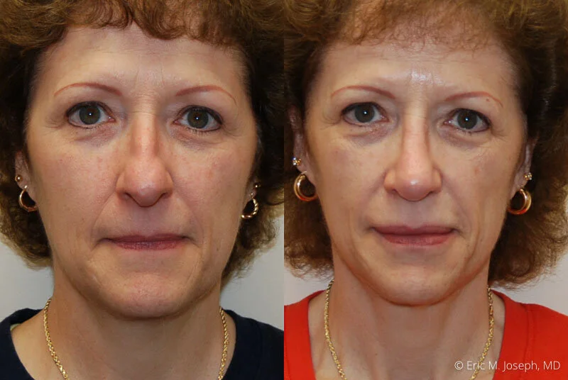 Rhinoplasty-0188.jpg
