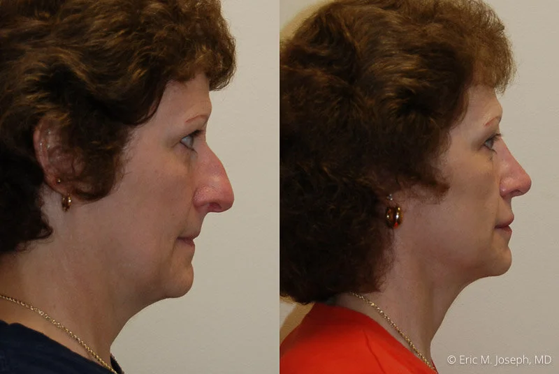 Rhinoplasty-0189.jpg