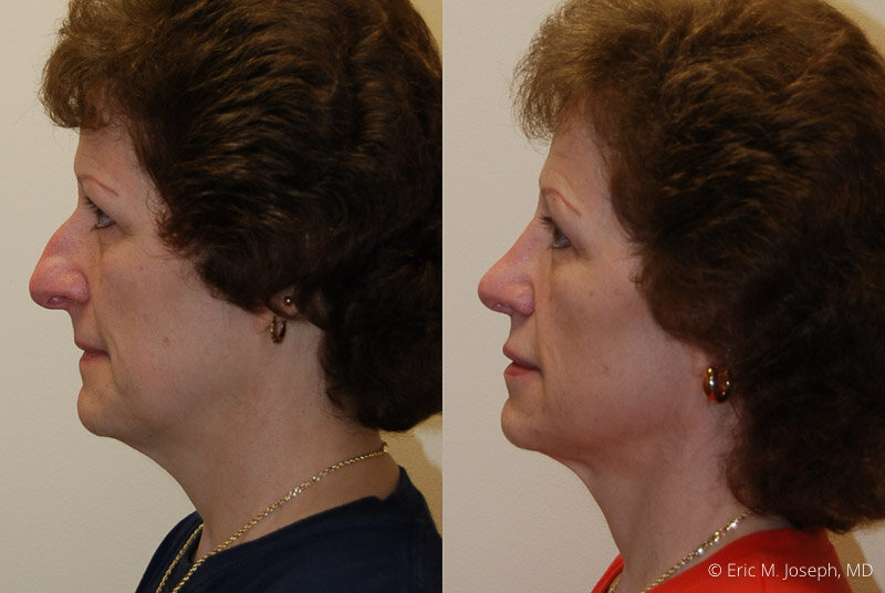 Rhinoplasty-0190.jpg