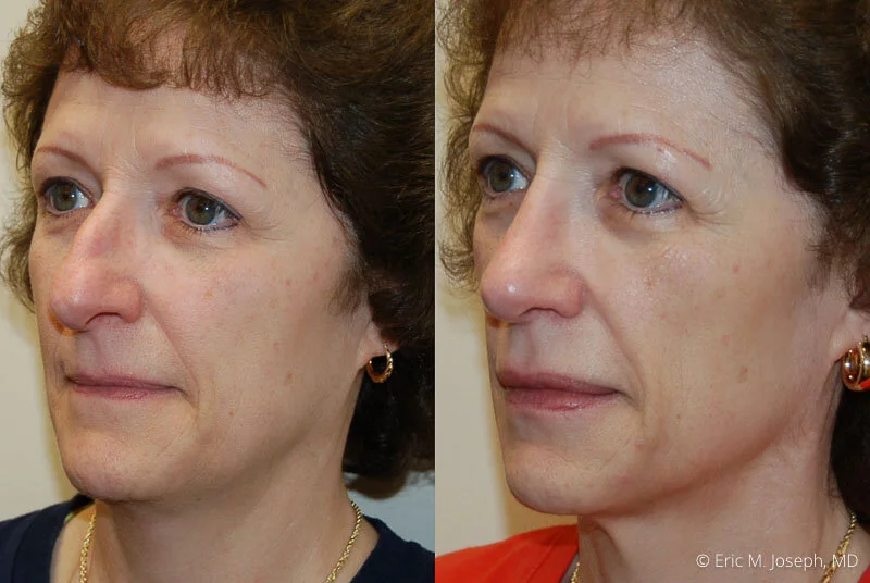 Rhinoplasty-0191.jpg