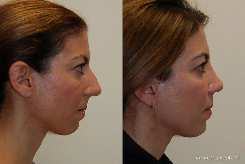 Rhinoplasty-0193.jpg
