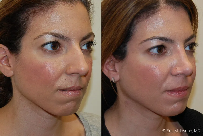Rhinoplasty-0194.jpg