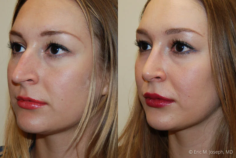 Rhinoplasty-0197.jpg