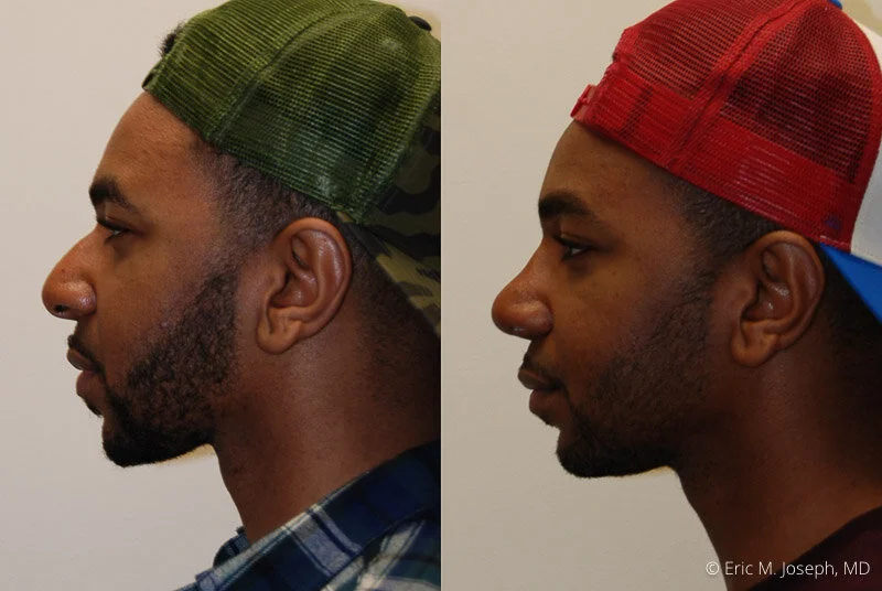 Rhinoplasty-0200.jpg