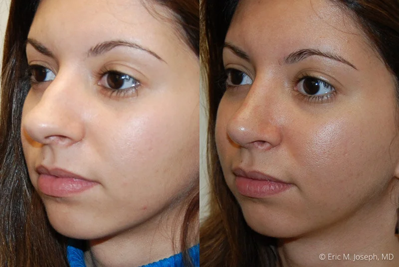 Rhinoplasty-0205.jpg
