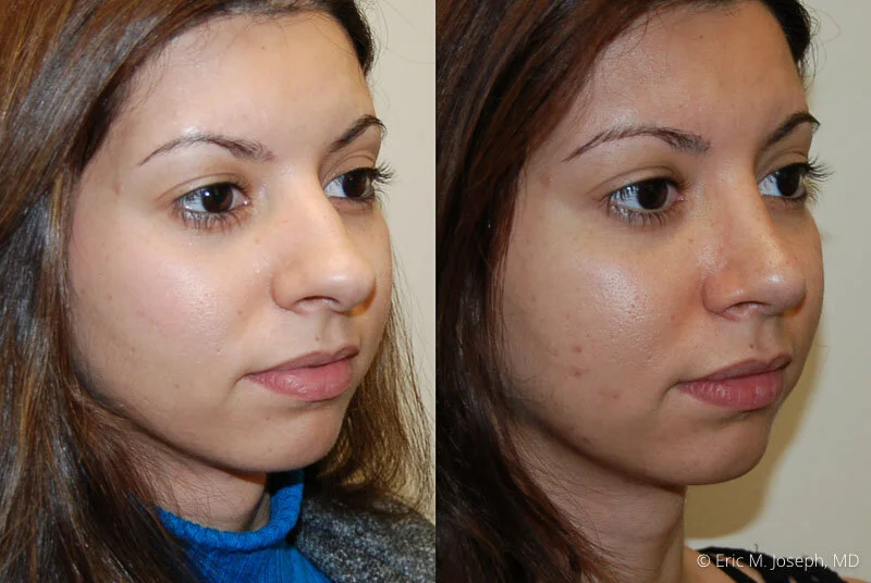 Rhinoplasty-0206.jpg