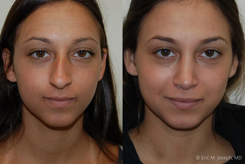 Rhinoplasty-0208.jpg