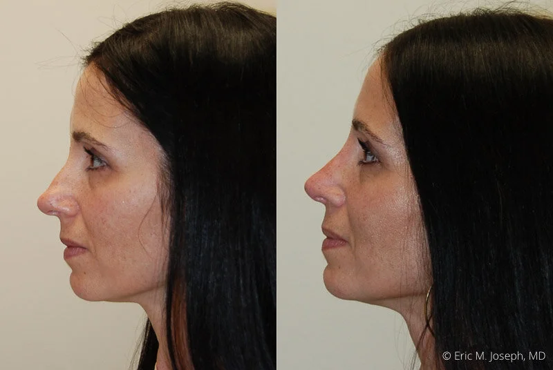 Rhinoplasty-0211.jpg