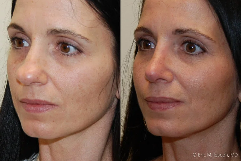 Rhinoplasty-0212.jpg