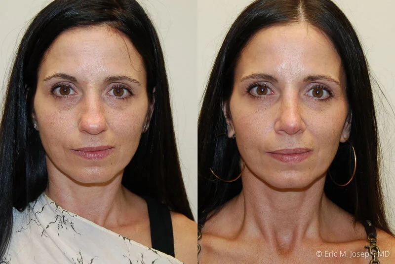 Rhinoplasty-0214.jpg