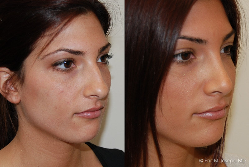 Rhinoplasty-0216.jpg