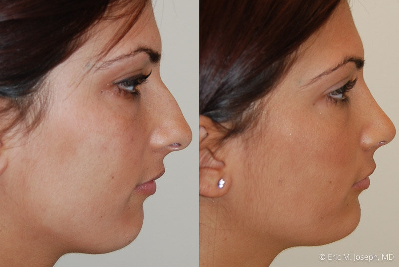 Rhinoplasty-0217.jpg