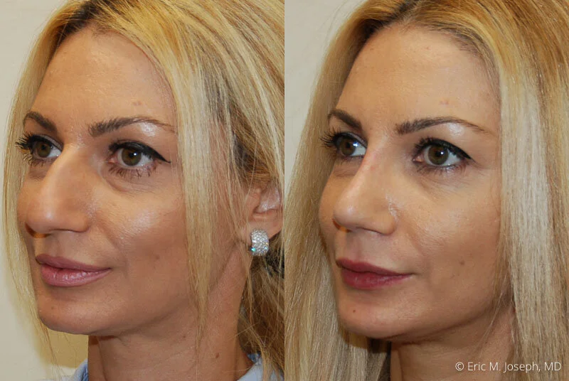 Rhinoplasty-0218.jpg