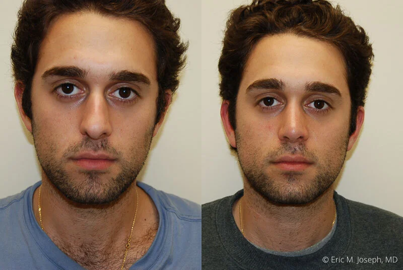 Rhinoplasty-0221.jpg