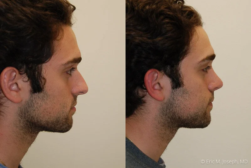 Rhinoplasty-0222.jpg