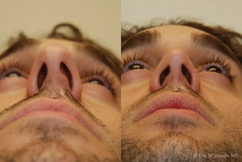 Rhinoplasty-0223.jpg