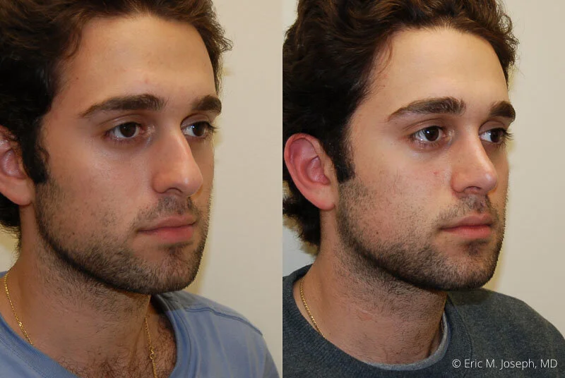 Rhinoplasty-0225.jpg