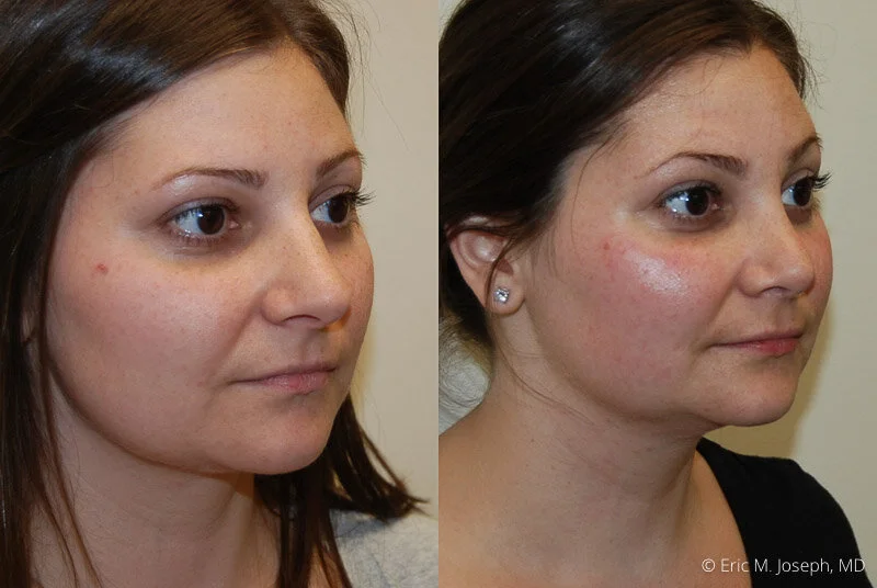 Rhinoplasty-0227.jpg
