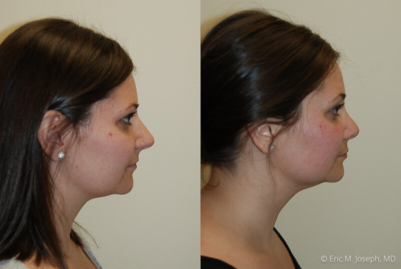 Rhinoplasty-0226.jpg