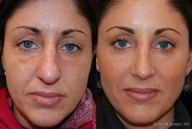 Rhinoplasty-0229.jpg