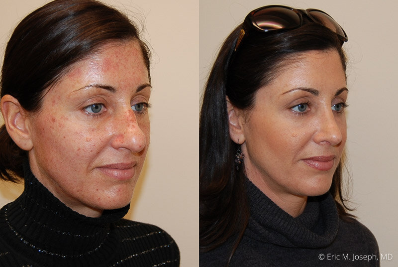 Rhinoplasty-0230.jpg