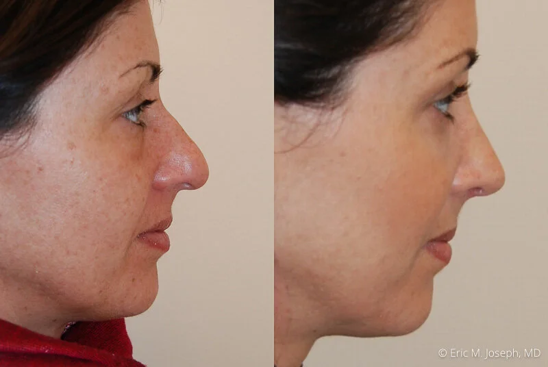 Rhinoplasty-0231.jpg