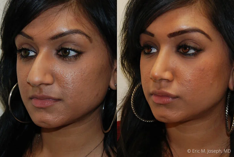 Rhinoplasty-0240.jpg