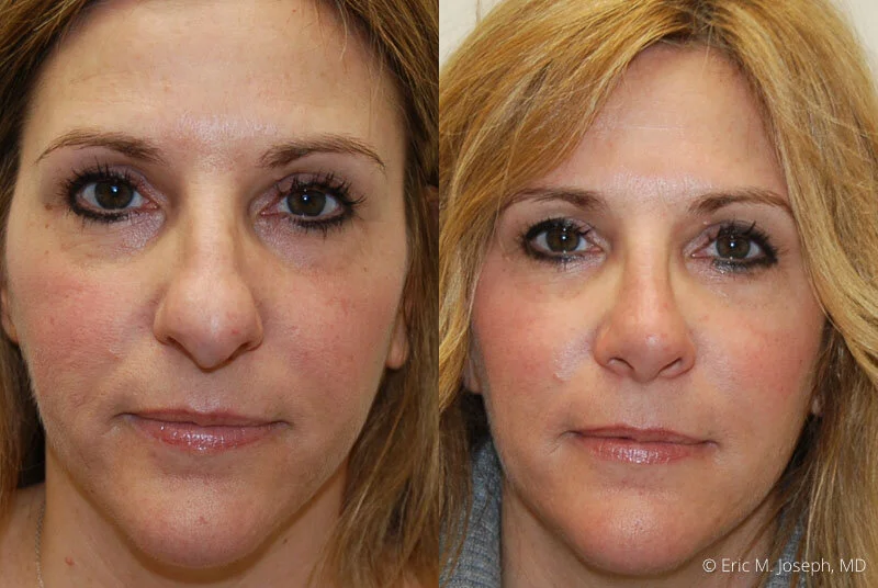 Rhinoplasty-0244.jpg