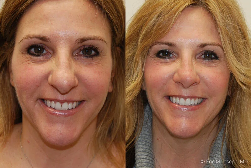 Rhinoplasty-0245.jpg