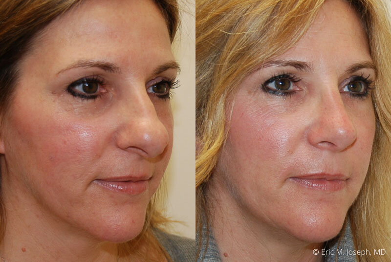 Rhinoplasty-0246.jpg