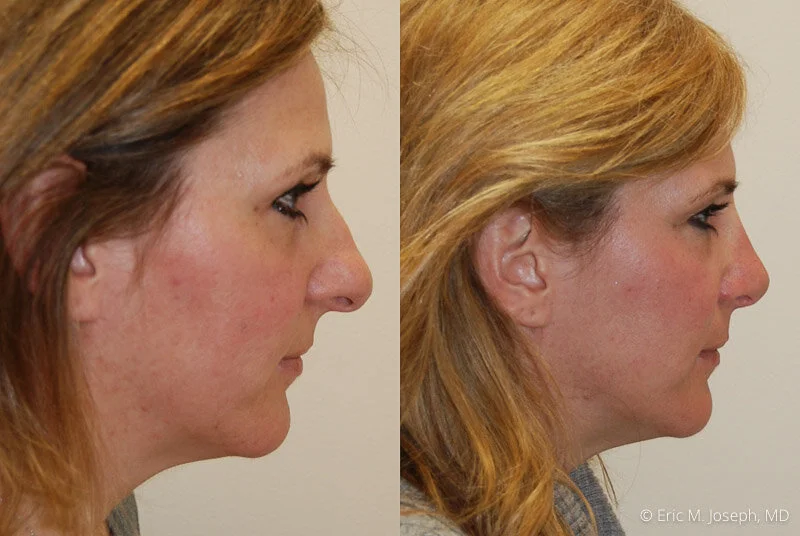 Rhinoplasty-0247.jpg