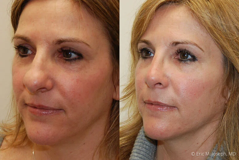 Rhinoplasty-0248.jpg
