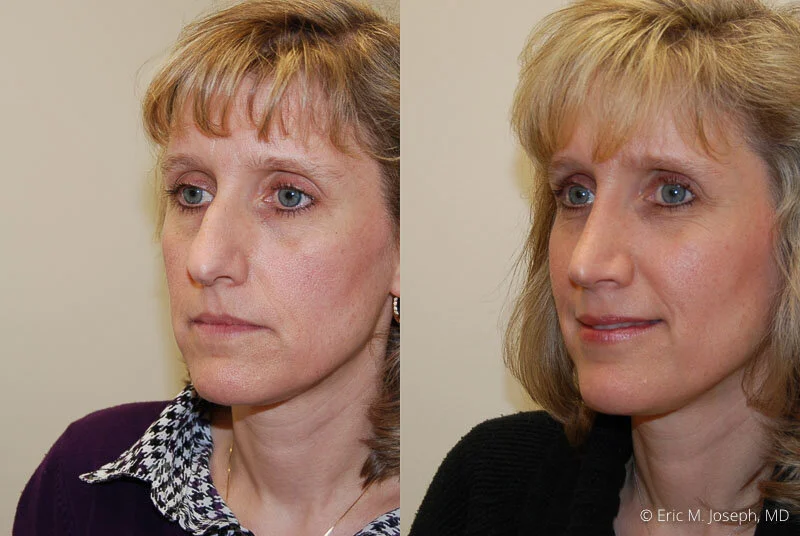 Rhinoplasty-0251.jpg