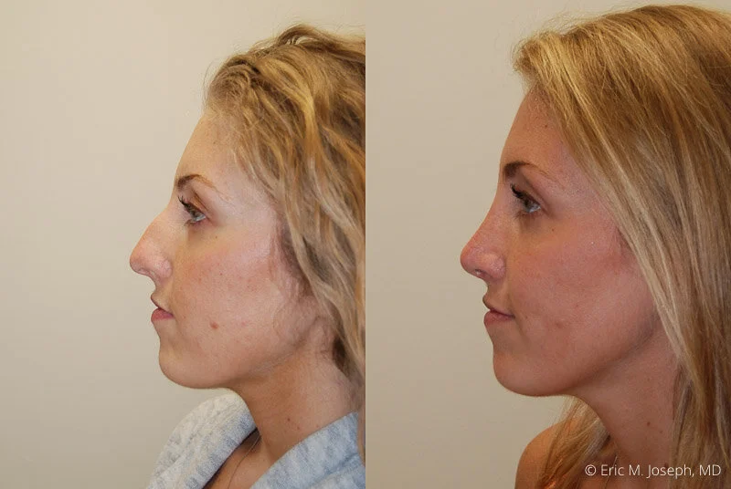 Rhinoplasty-0252.jpg