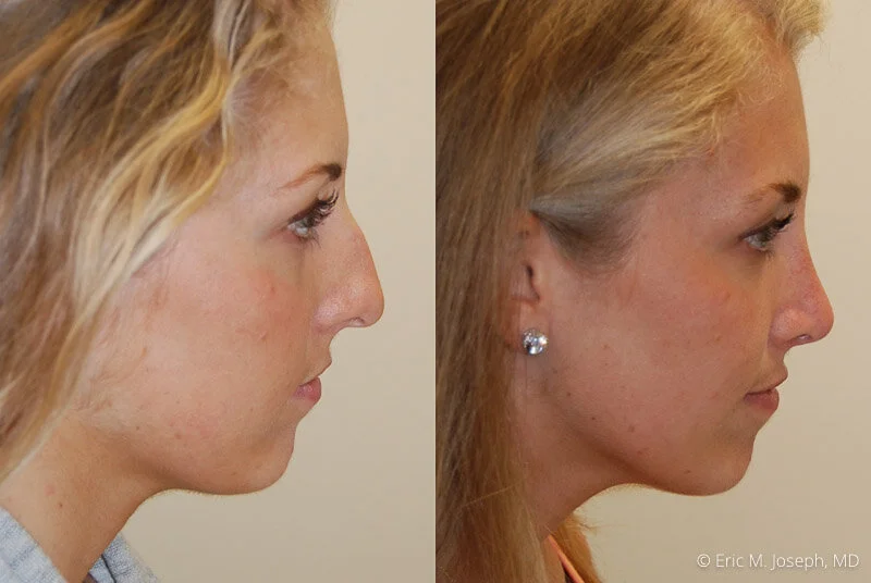 Rhinoplasty-0254.jpg