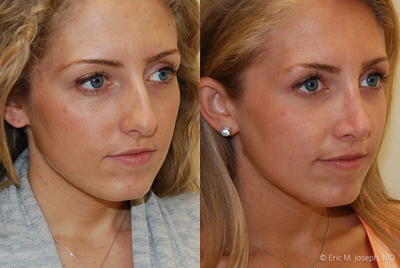 Rhinoplasty-0255.jpg