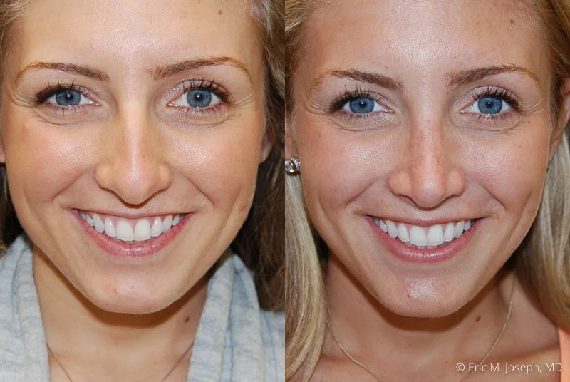 Rhinoplasty-0256.jpg