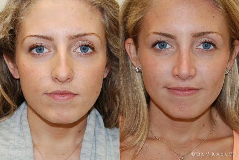 Rhinoplasty-0257.jpg
