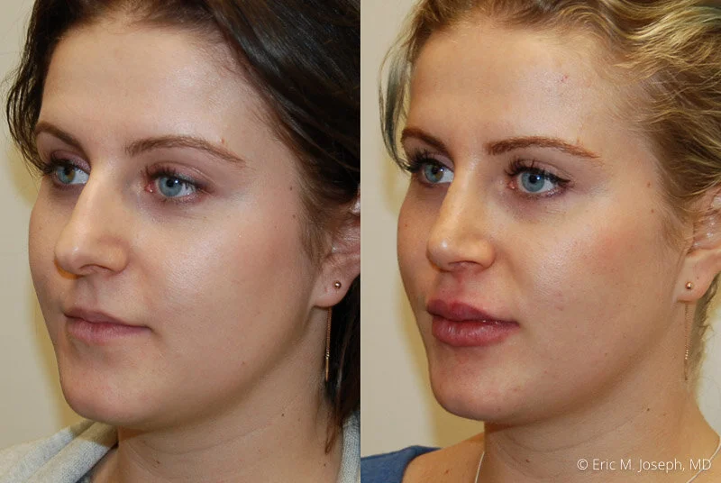 Rhinoplasty-0260.jpg