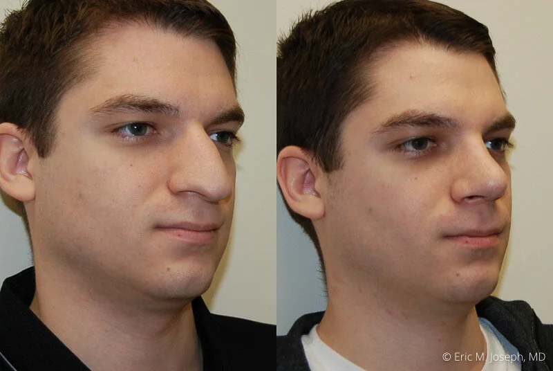 Rhinoplasty-0271.jpg