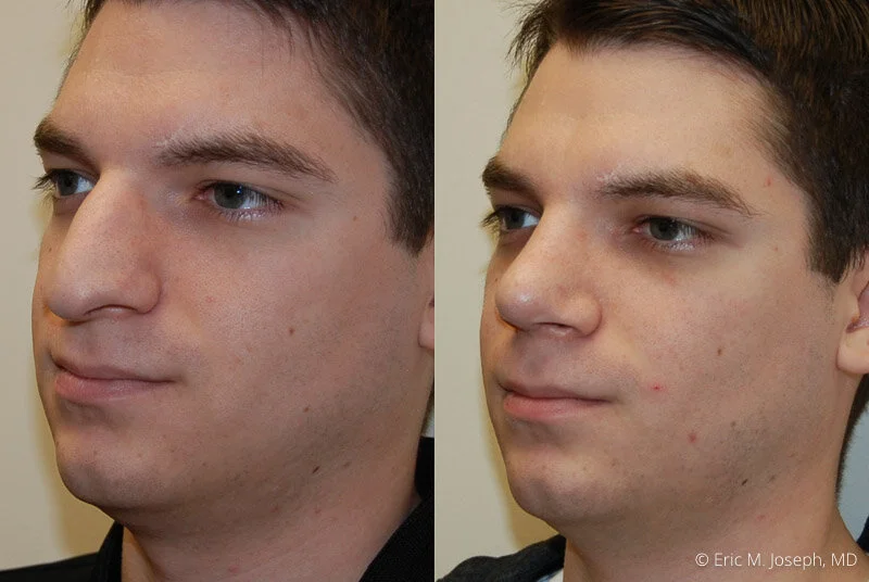 Rhinoplasty-0270.jpg