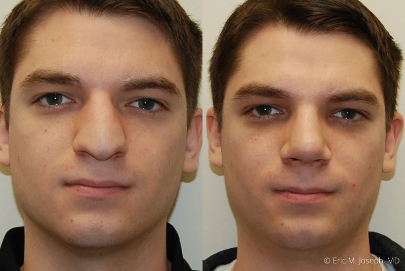 Rhinoplasty-0276.jpg