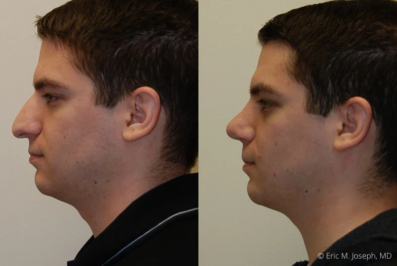 Rhinoplasty-0277.jpg