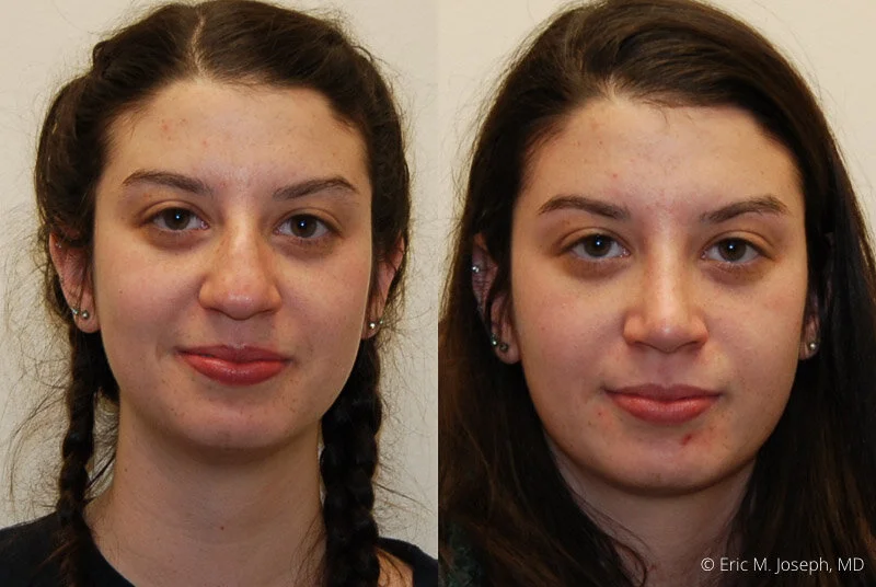 Rhinoplasty-0279.jpg