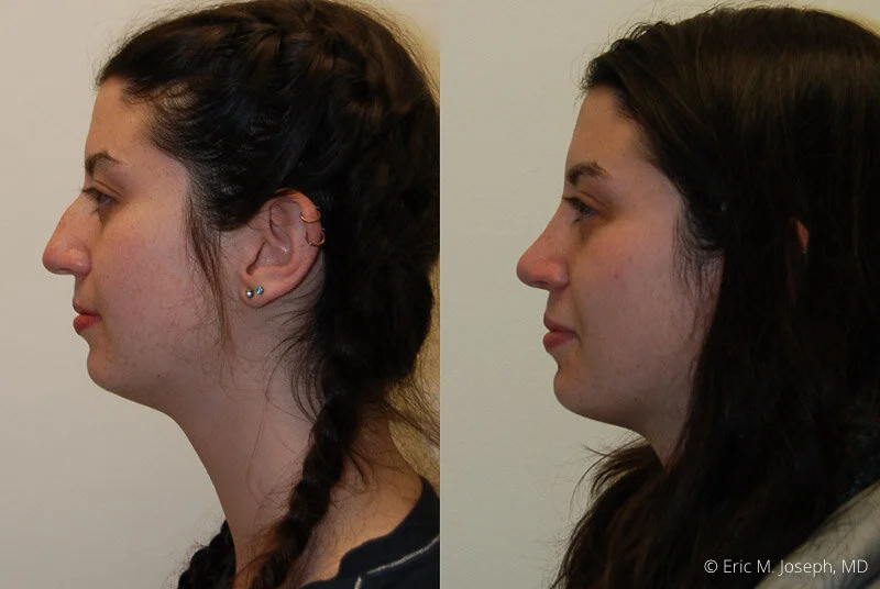 Rhinoplasty-0280.jpg
