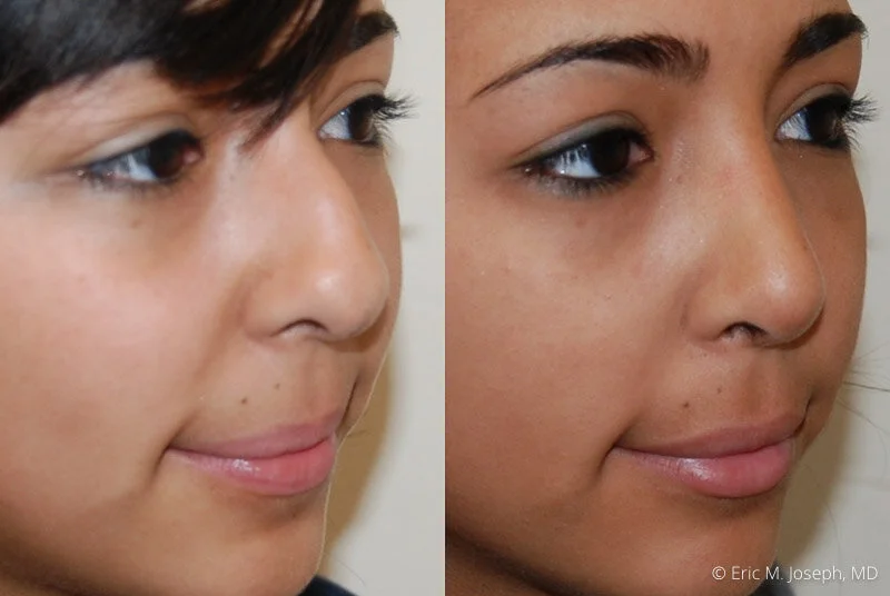 Rhinoplasty-0284.jpg