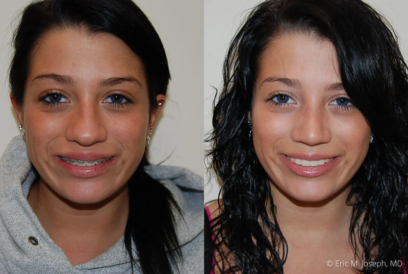 Rhinoplasty-0286.jpg