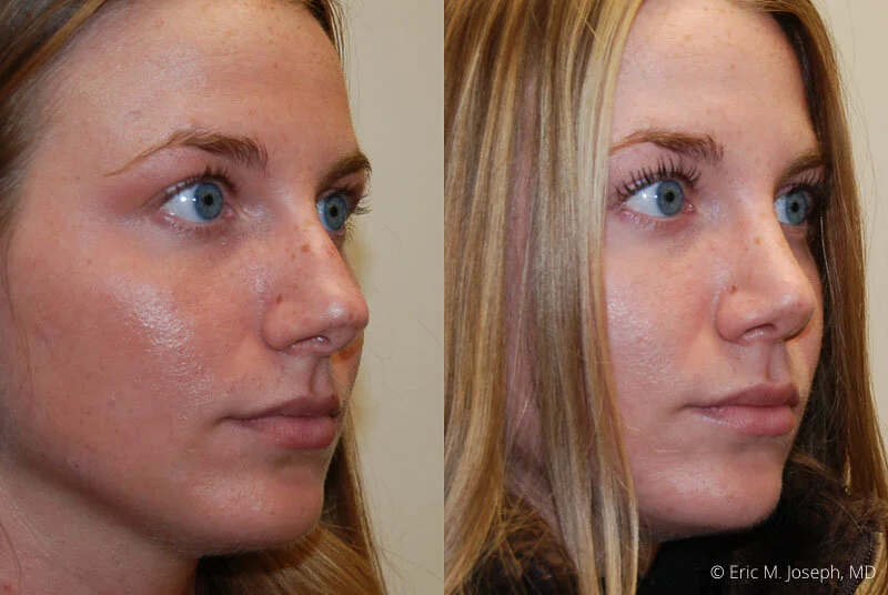 Rhinoplasty-0297.jpg