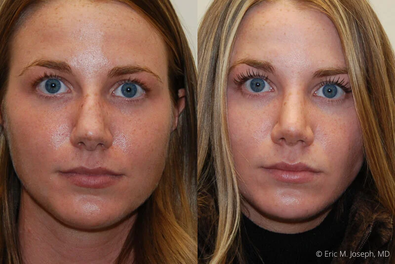 Rhinoplasty-0298.jpg
