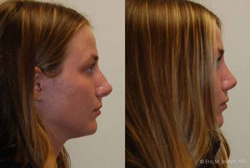 Rhinoplasty-0299.jpg